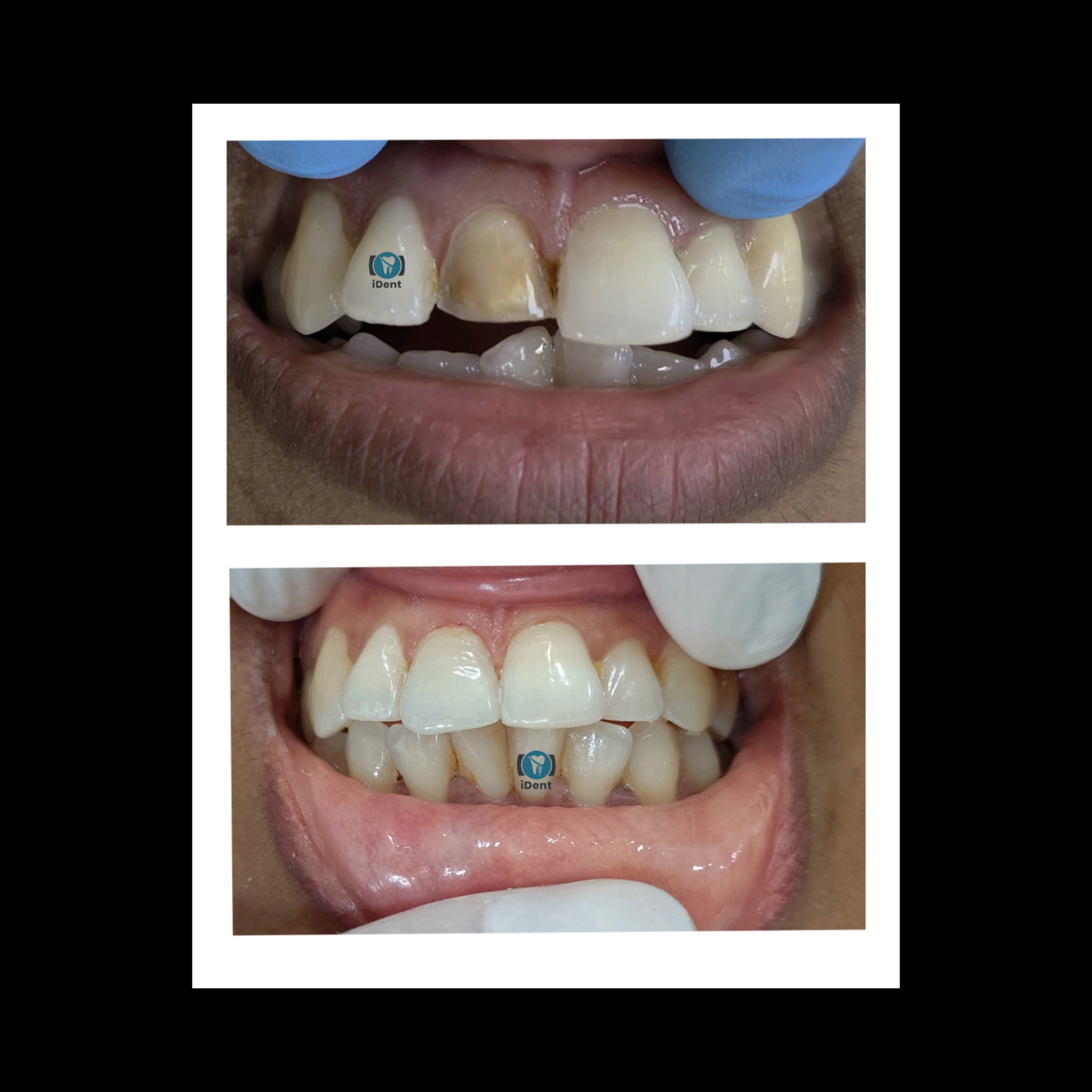 Before and after dental implant treatment